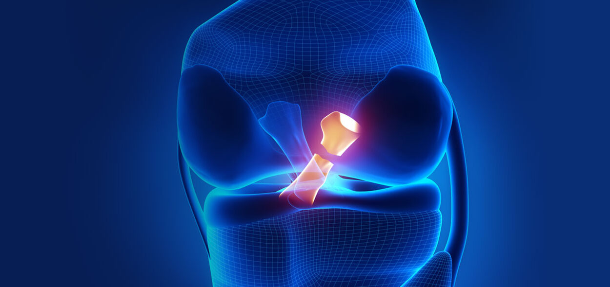 Lesão do Ligamento Cruzado Anterior