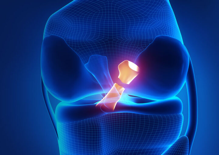 Lesão do Ligamento Cruzado Anterior