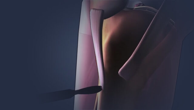 animação cirúrgica