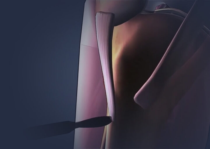 animação cirúrgica