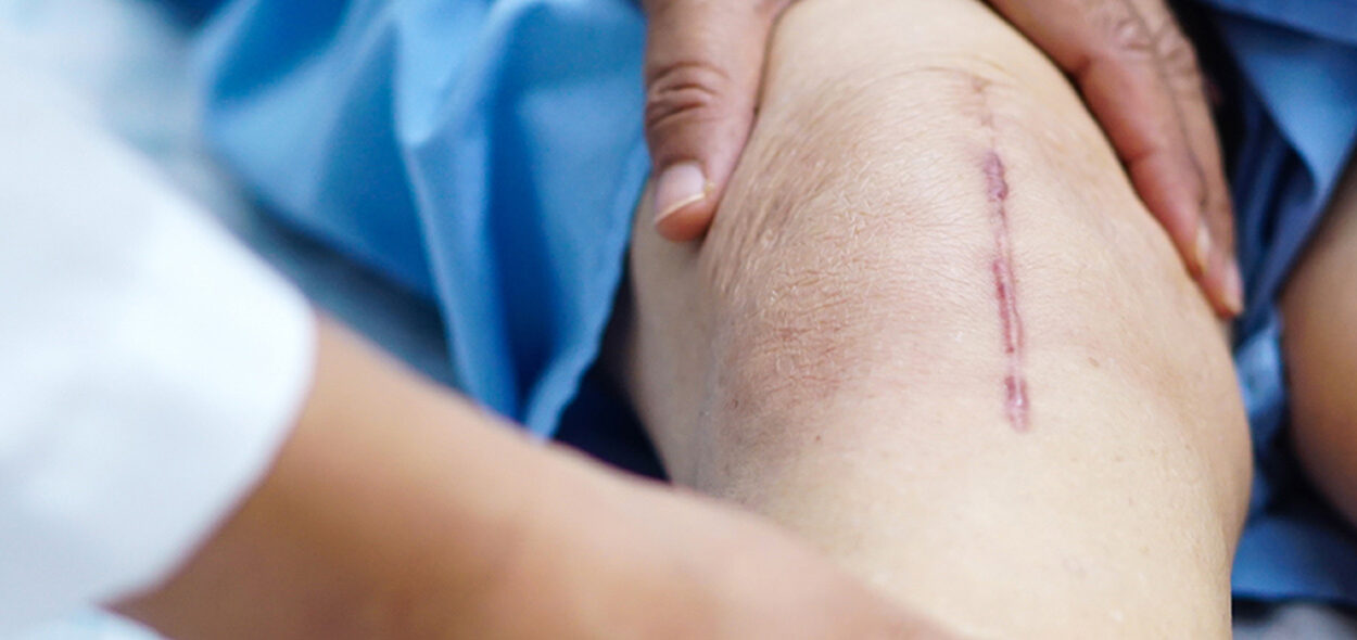 cicatriz no joelho