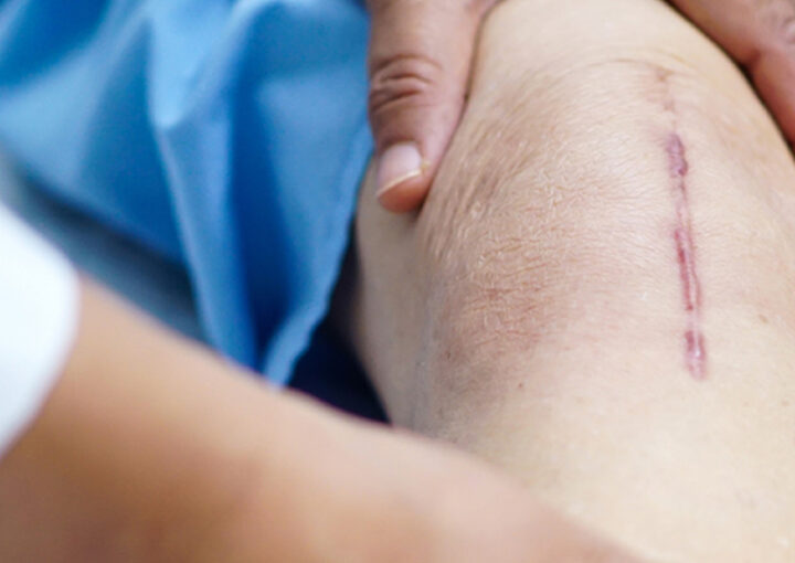 cicatriz no joelho