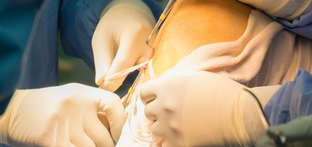 Ruptura do ligamento cruzado