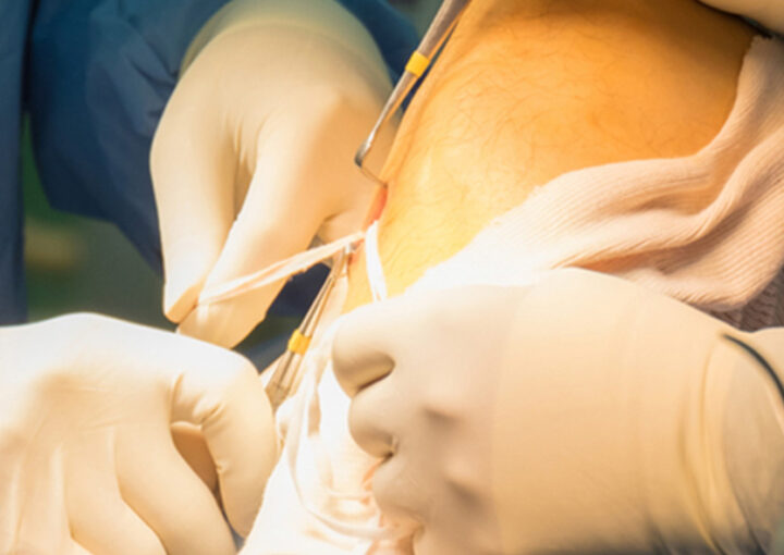 Ruptura do ligamento cruzado